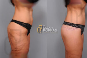 dr-oscar-porras-lower-body-lift