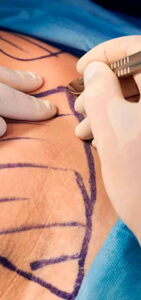 excess-skin-removal-after-bariatric-surgery-dr-porras-tijuana-mexico-3