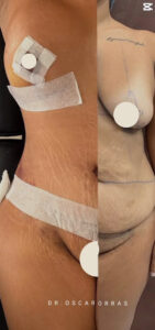 mommy-make-over-dr-porras-cirujano-plástico-tijuana-surgeon-mexico-1a