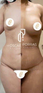 mommy-make-over-dr-porras-cirujano-plástico-tijuana-surgeon-mexico-6a
